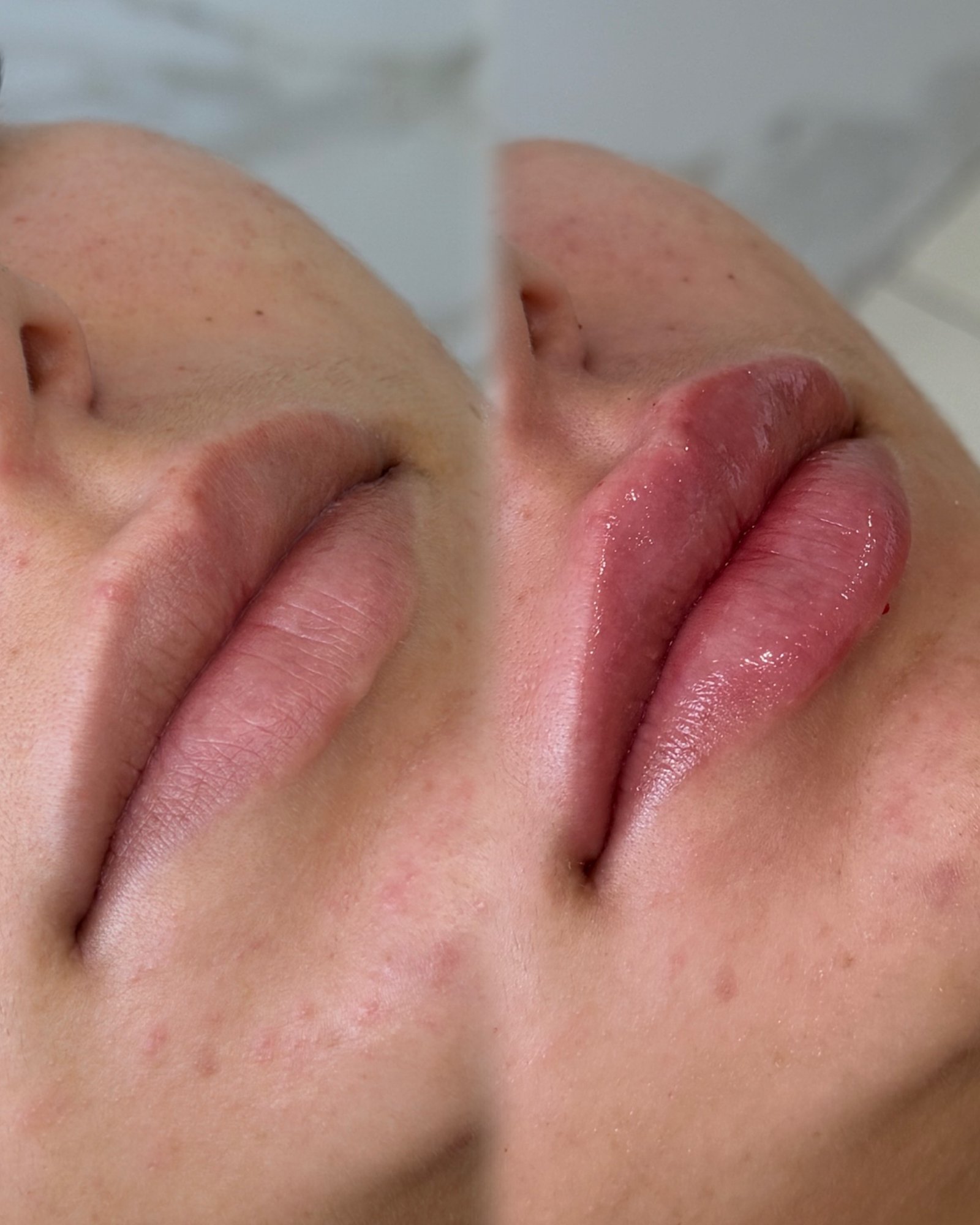 Registro clínico de preenchimento labial